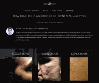 Acne-Scar-Treatment.com(Acne Scar Treatment) Screenshot