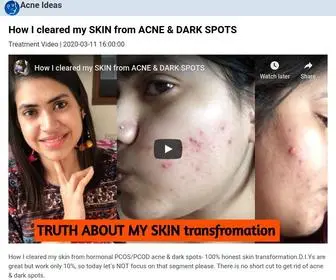 Acneideas.com(Acne Ideas) Screenshot