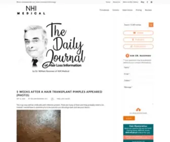Baldingblog.com(The Daily Journal of Hair Loss Information) Screenshot