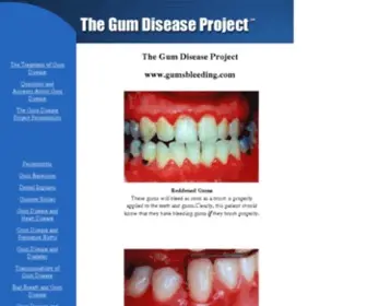 Gumsbleeding.com(The Gum Disease Project) Screenshot